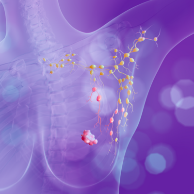 Ganglio Centinela: Innovación y Avances en Oncología